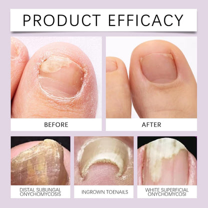 Bee Venom Nail Treatment Serum [Repair Your Nail] Buy 1 Get 1 Free 😍